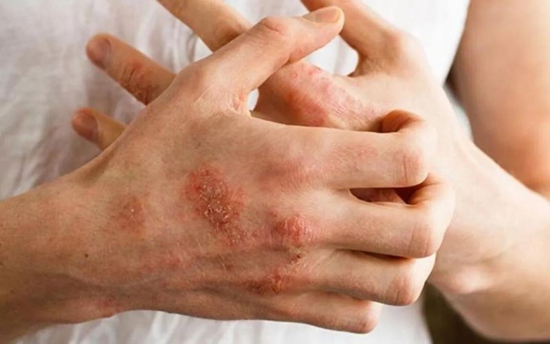 Hametan Krem Egzama İçin İyi midir?
