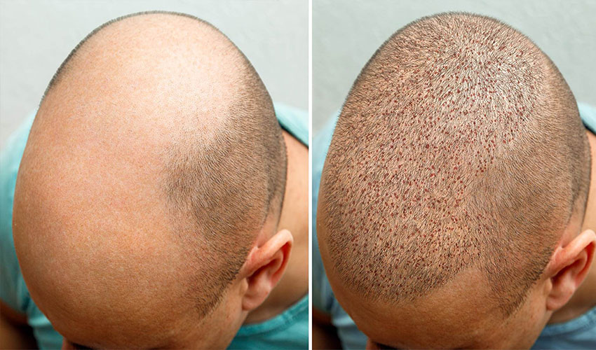 How Much Is A Full Head Hair Transplant In Turkey