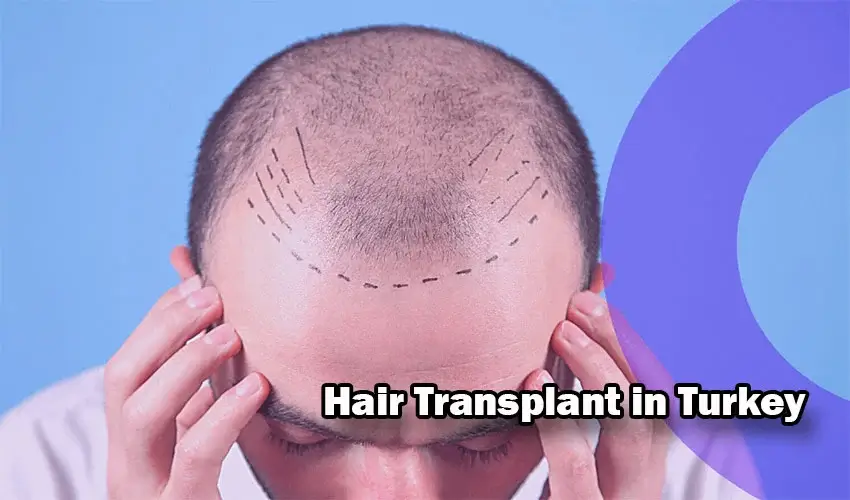 Why hair transplant in Turkey? How much are hair transplant prices in  Turkey 2023-2024 ? | Öğrenci Gündemi
