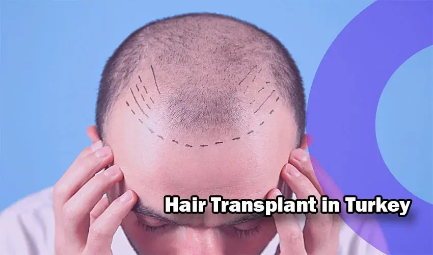 Why hair transplant in Turkey? How much are hair transplant prices in